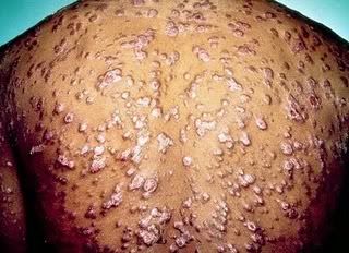 Tanda gejala penyakit sipilis bagi wanita sifilis gambar orang Tanda gejala penyakit sipilis bagi wanita sifilis gambar orang