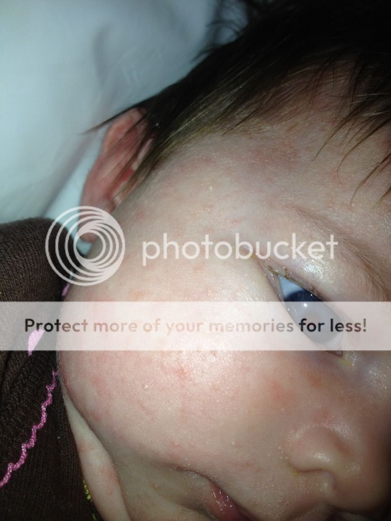 Updated With Pics Infant Acne Heat Rash Or Something Else Babycenter